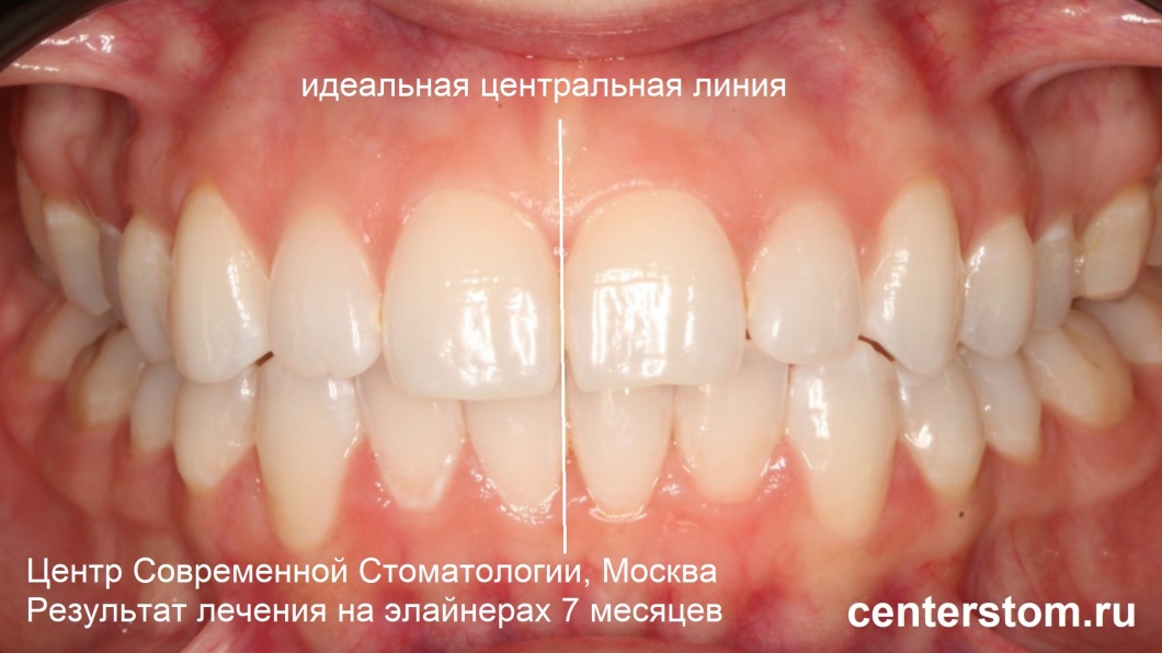 Центральная линия зубов приведена в идеальное состояние! Лечение на элайнерах заняло 7 месяцев