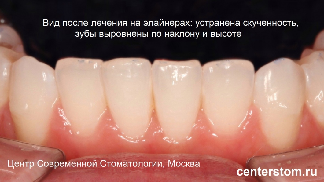 Вид передних нижних зубов через 7 месяцев лечения на элайнерах