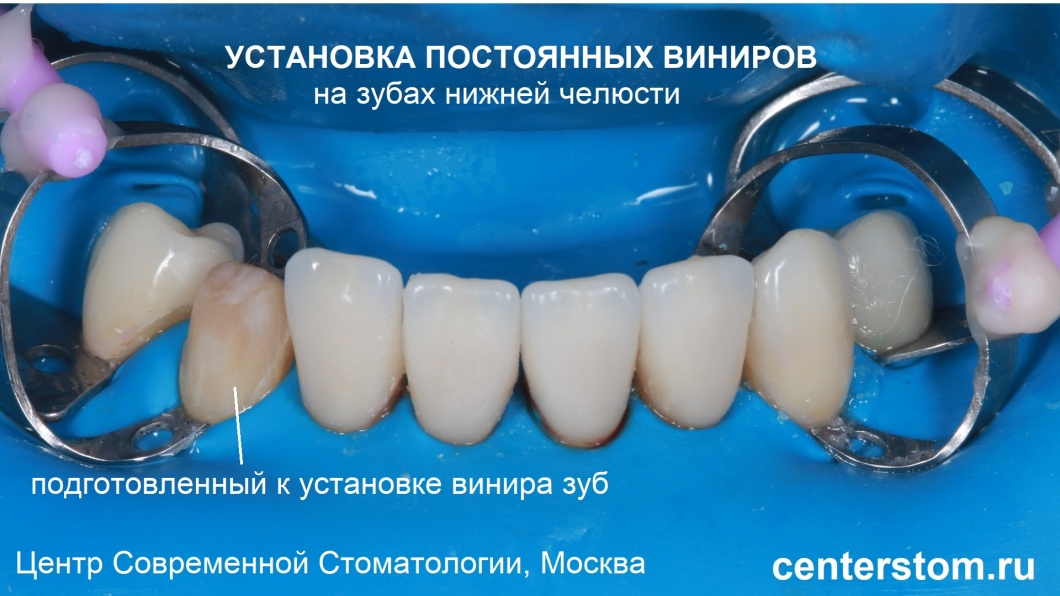 На фото — фиксация виниров на нижние зубы
