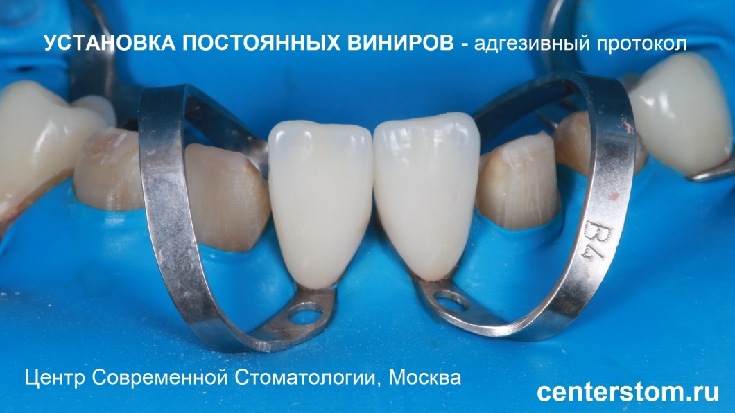 На фото — фиксация виниров на первые два нижних зуба 