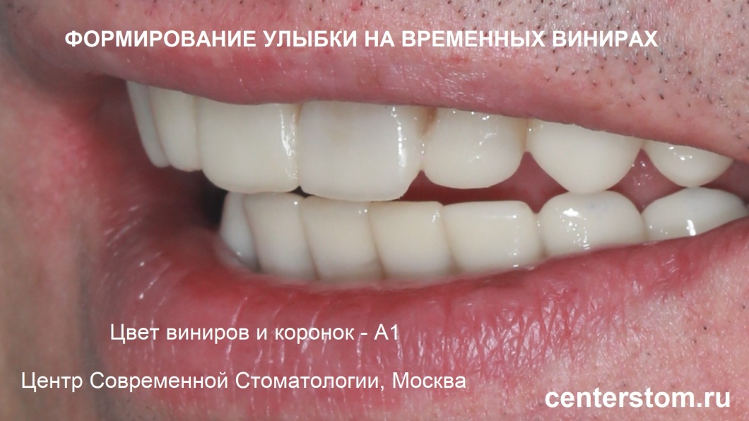 Цвет зубов в мокап у временных виниров — однотонный, А1