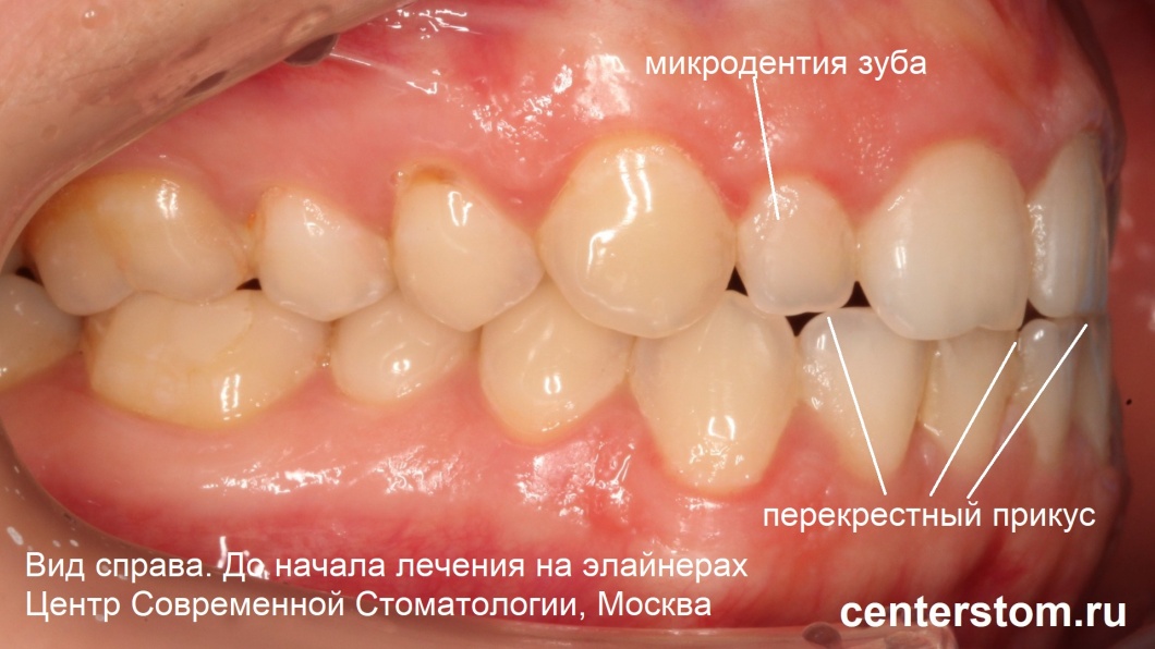 Вид зубов до начала ортодонтического лечения на элайнерах. Диагноз - перекрестный прикус, скученность зубов, микродентия