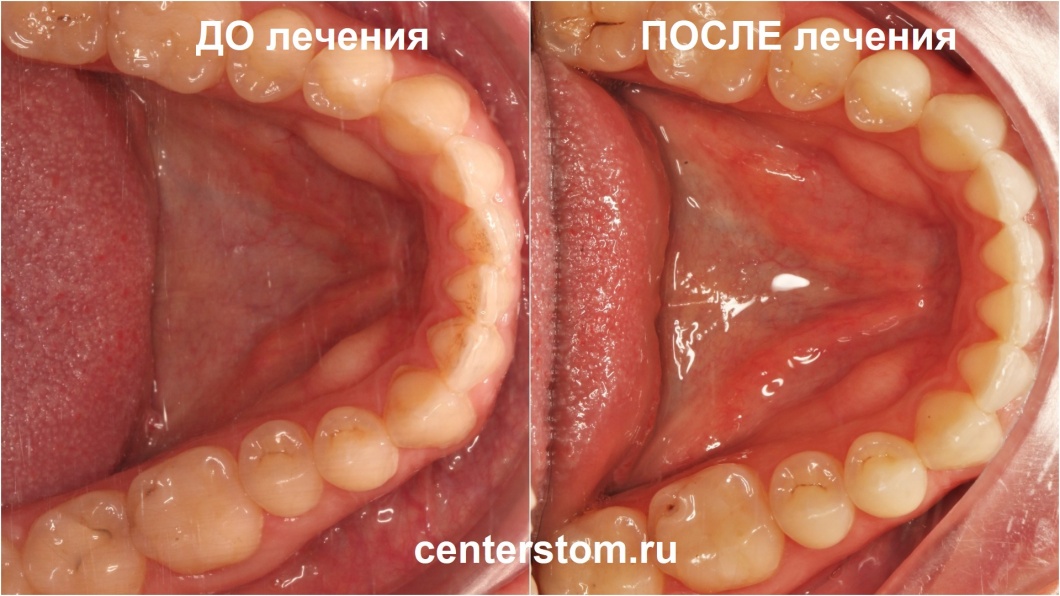 фото нижней челюсти до и после лечения перекрестного прикуса и скученности зубов. Центр Современной Стоматологии, Москва