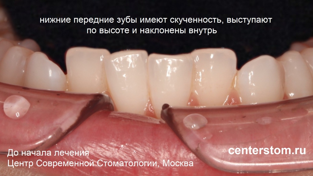 Особую озабоченность у пациентки вызывали нижние зубы