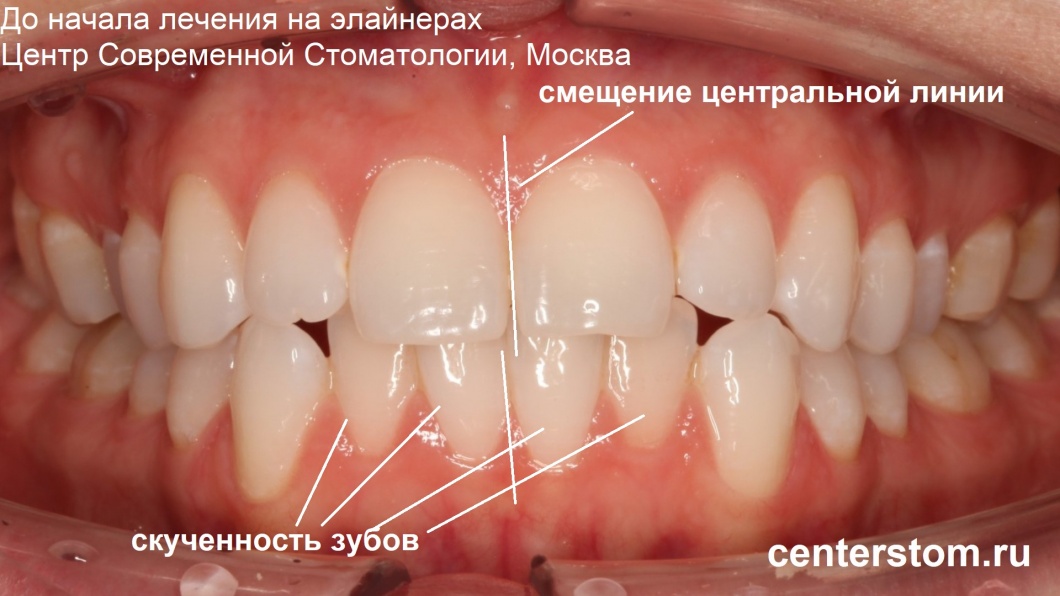 Скученность передних зубов и нарушение центральной линии - с такими проблемами обратилась пациентка