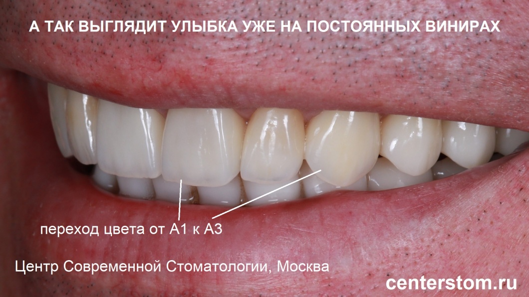 На фото — постоянные виниры и коронки установлены на зубы пациента
