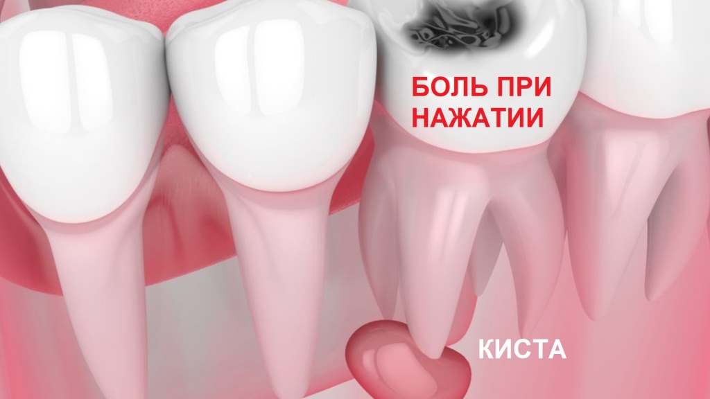 Киста зуба - одна из причин возникновения боли под коронкой
