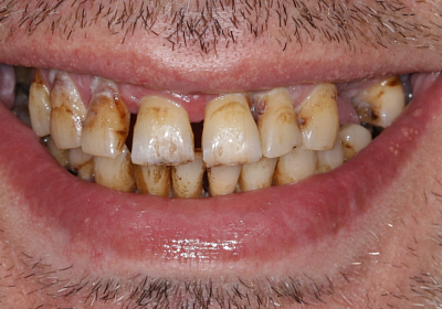 Фото до Тотальное восстановление зубов по протоколу All-on-8 