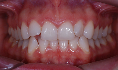 Фото до «Невидимое» лечение скученности зубов