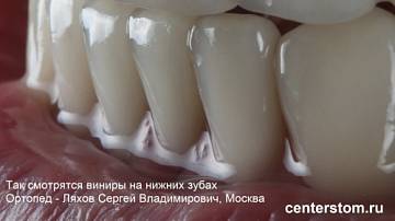 Виниры на нижние зубы: безупречная коррекция зубного ряда