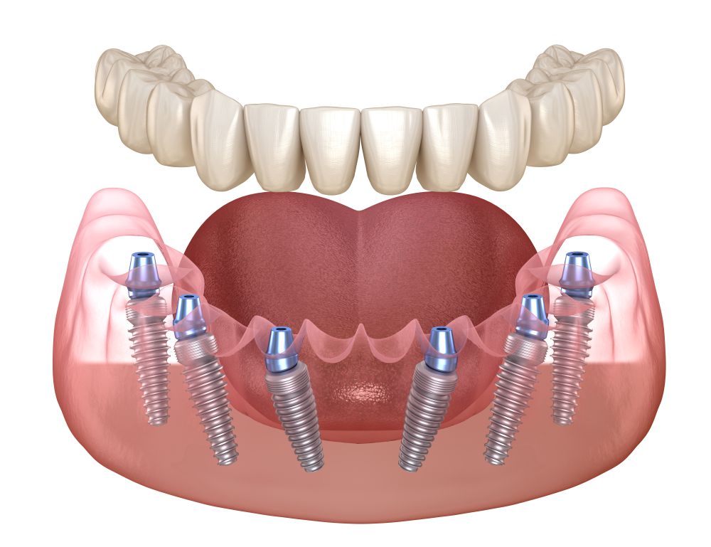Несъемные зубные протезы на 6 имплантах