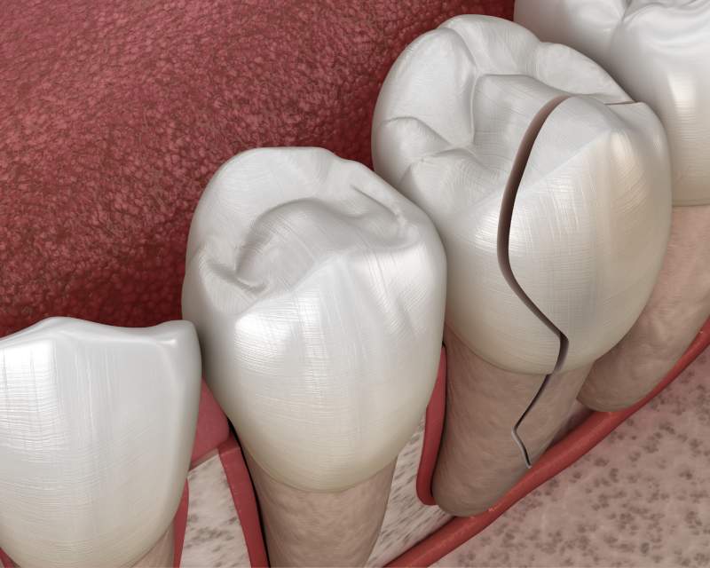 Показания к быстрой имплантации зубов