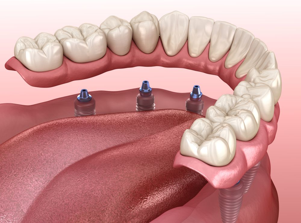 Имплантация челюсти при полном отсутствии зубов