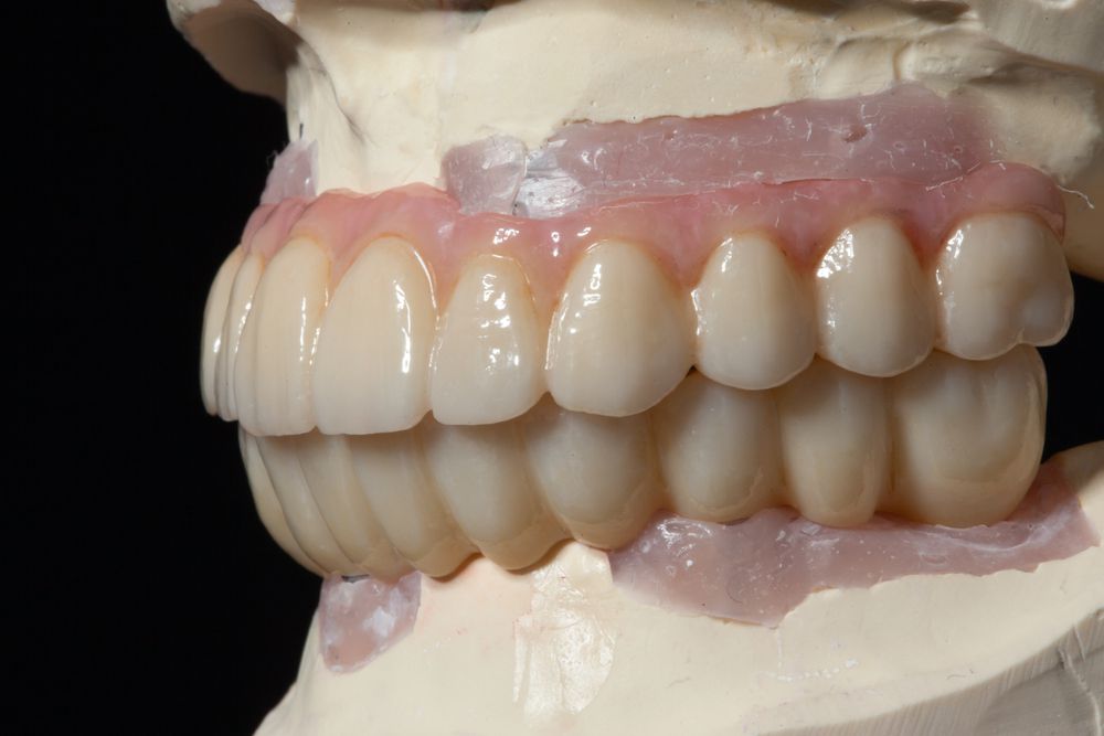Как проводится имплантация при полном отсутствии зубов
