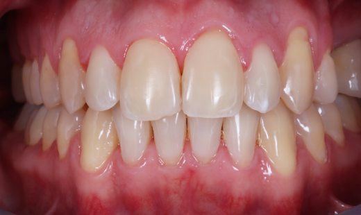 Фото после Мезиальная окклюзия, скученное положение зубов нижней челюсти