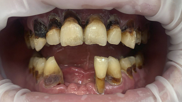 Фото до Полное восстановление всех зубов по протоколу All-on-8 в условиях седации для пациента с боязнью стоматологов