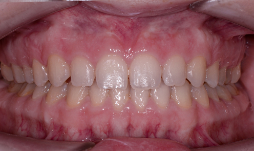 Фото после «Редкие зубы» - коррекция увеличенных межзубных промежутков и крупной диастемы между передними нижними резцами