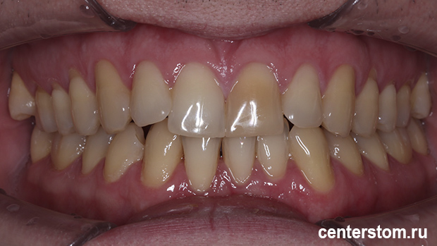 Фото до Мы выровняли зубы, сохранив здоровье дёсен - лечение пациента со склонностью к рецессии