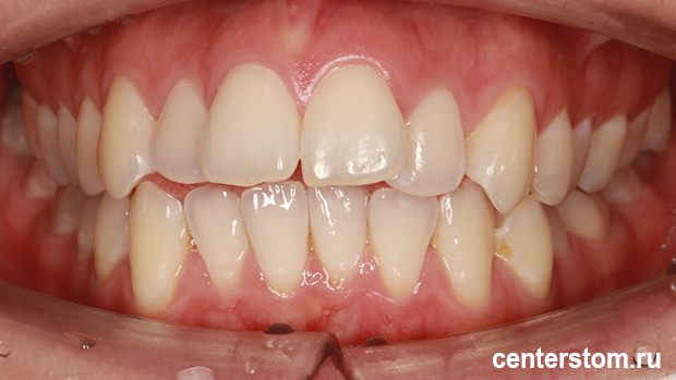 Фото до Мы исправили «детскую» проблему прикуса у взрослой пациентки