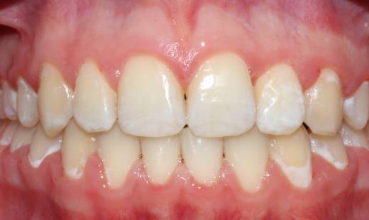 Перекрестное смыкание зубов в области резца верхней челюсти