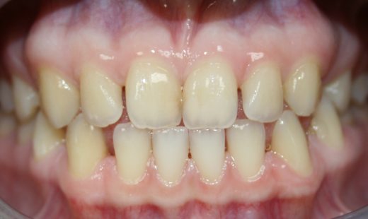 Фото до Тремы, диастема, первичная адентия зуба