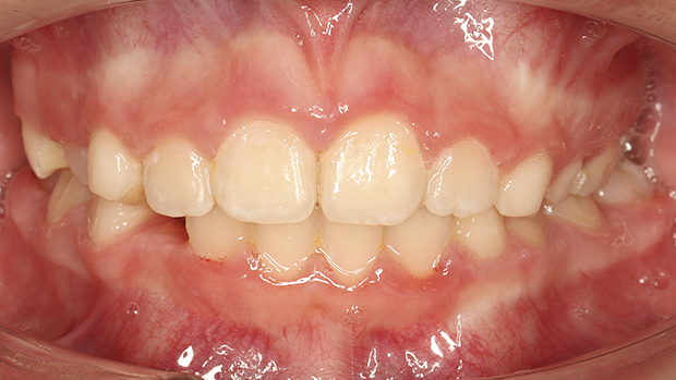 Фото после Раннее вмешательство: расширение челюсти в 9 лет, чтобы избежать сложностей в будущем