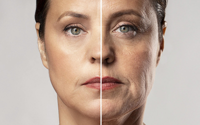 Асимметрия лица