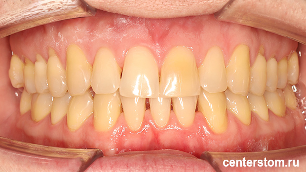 Фото после Мы выровняли зубы, сохранив здоровье дёсен - лечение пациента со склонностью к рецессии