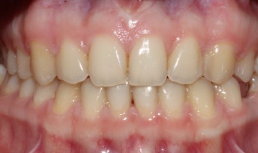 Фото после Тремы, диастема, первичная адентия зуба