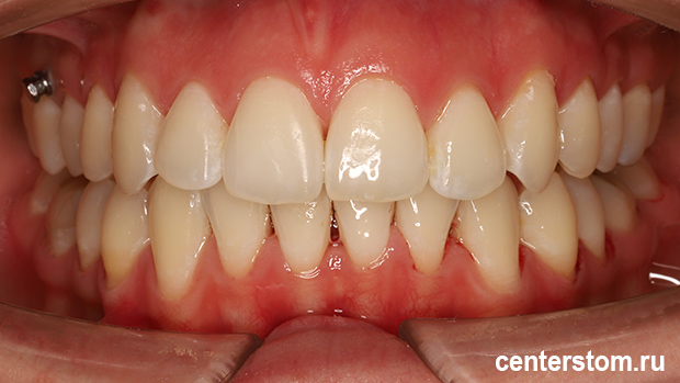 Фото после Мы исправили «детскую» проблему прикуса у взрослой пациентки