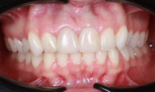Процедуры домашнего отбеливания зубов