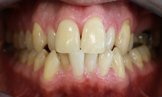 Мезиальная окклюзия, скученное положение зубов нижней челюсти