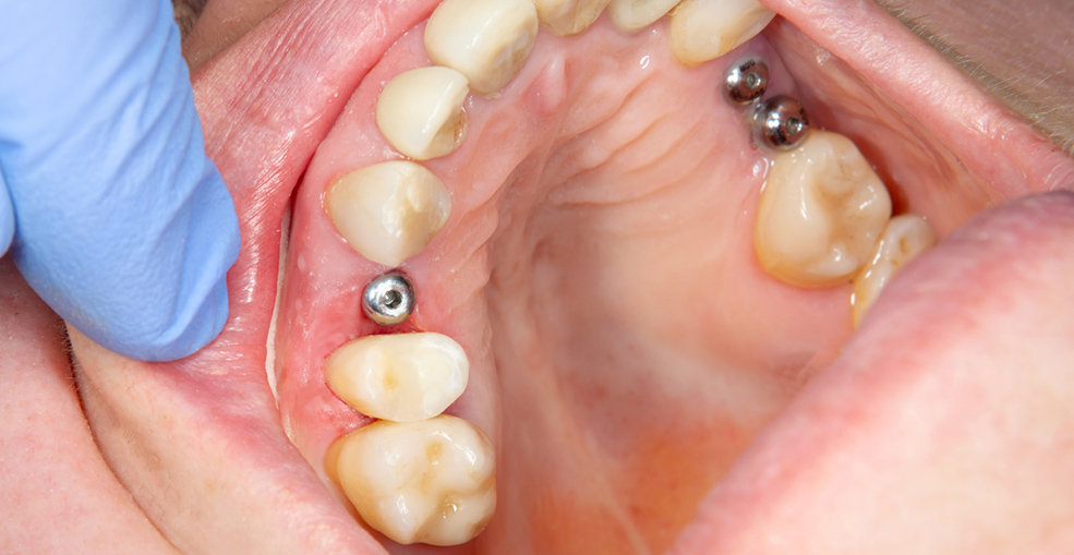 Формирователь десны, установленный на имплант