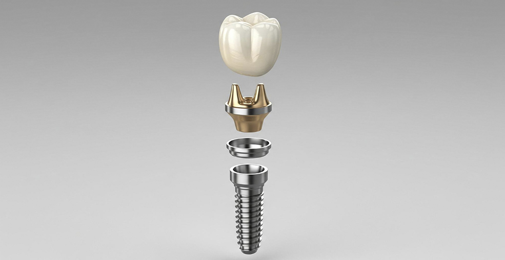 Строение дентального импланта: имплант, абатмент, коронка