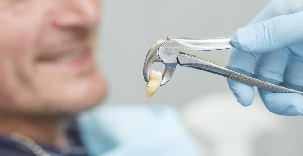 Кровотечение после удаления зуба