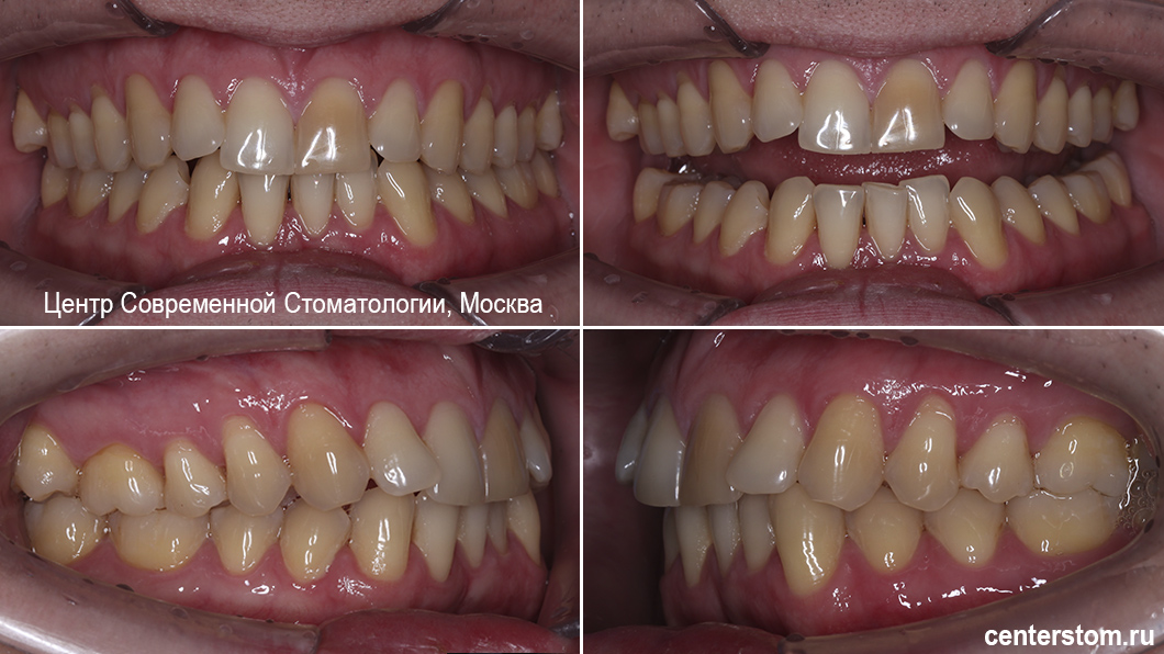 Скученность зубов, отсутствие одного нижнего резца, эстетический дискомфорт и выраженная склонность к рецессии Скученность зубов, отсутствие одного нижнего резца, эстетический дискомфорт и выраженная склонность к рецессии