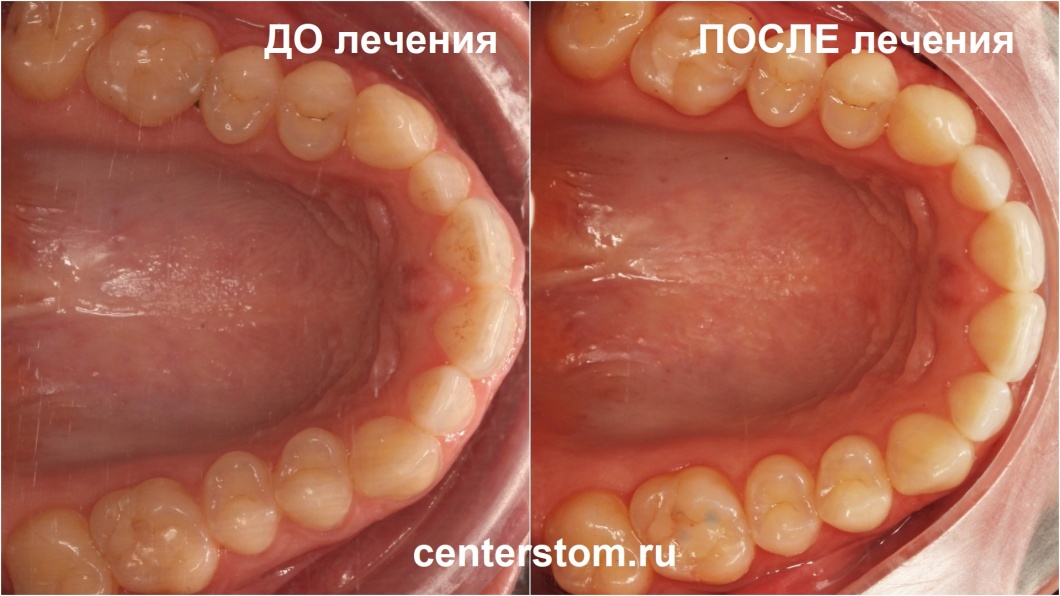 Фото верхней челюсти до и после ортодонтического лечения перекрестного прикуса и скученности зубов. Центр Современной Стоматологии, Москва
