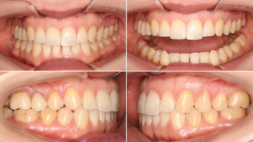 Ровные зубы