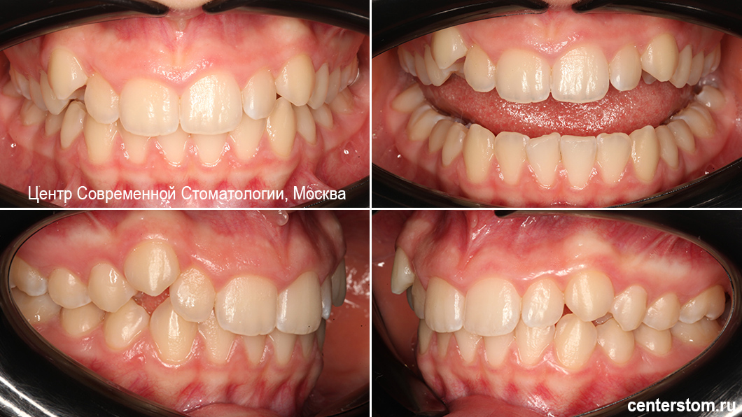 Выпирающие клыки наверху, неровность зубов