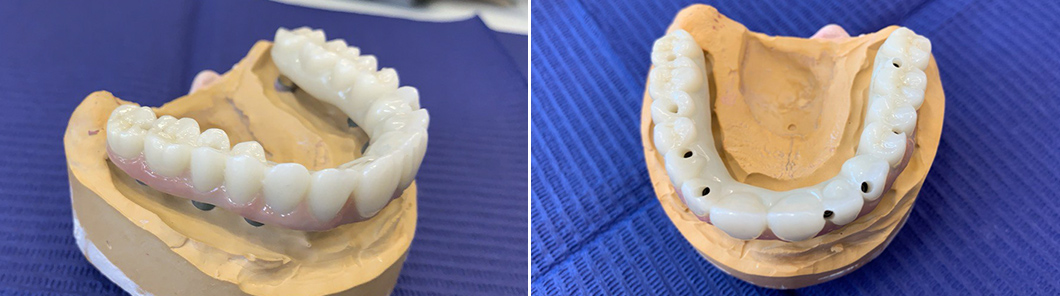 Изготовление 2 встречных протезов