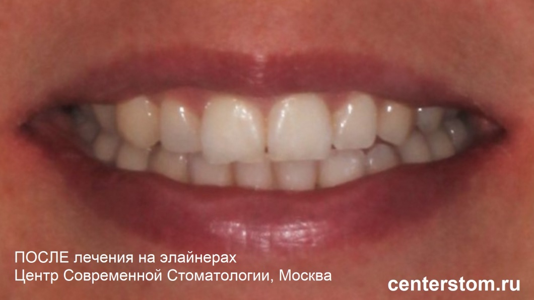 Улыбка после лечения перекрестного прикуса на элайнерах. Фото - Центр Современной Стоматологии, Москва