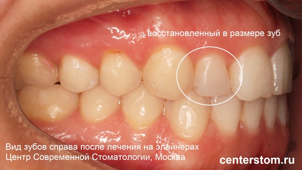 Фото лечения перекрестного прикуса на элайнерах. После снятия элайнеров. Центр Современной Стоматологии, Москва