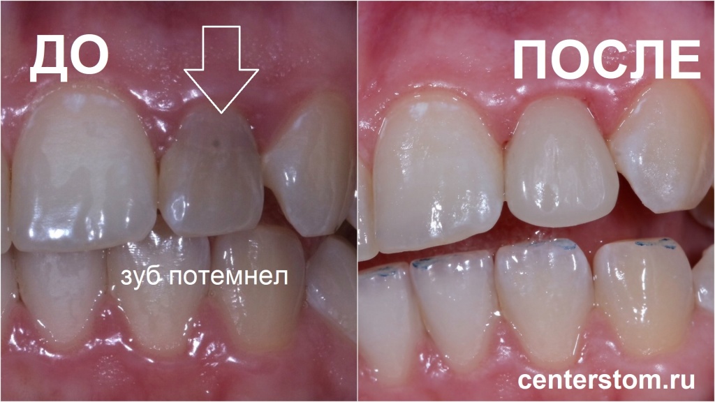Так выглядит черный зуб до и после лечения. Пример из клинической практики стоматологии Центрстом на Бауманской, Москва