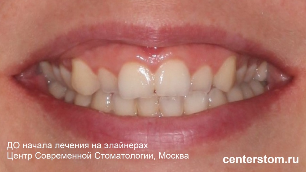 Вид улыбки до начала лечения перекрестного прикуса на элайнерах. Фото - Центр Современной Стоматологии, Москва