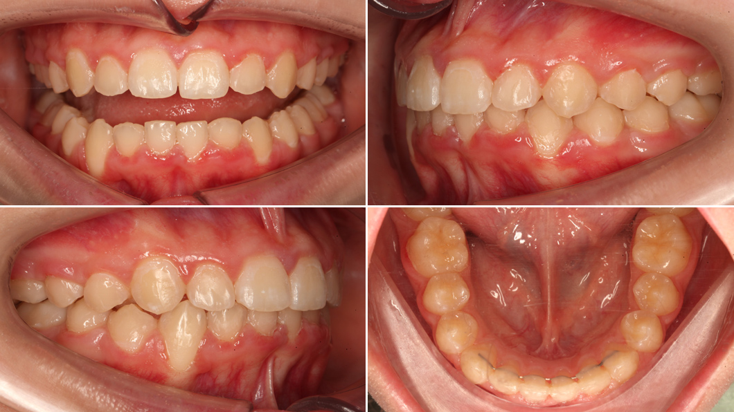 Ровные красвые зубы Ровные красвые зубы