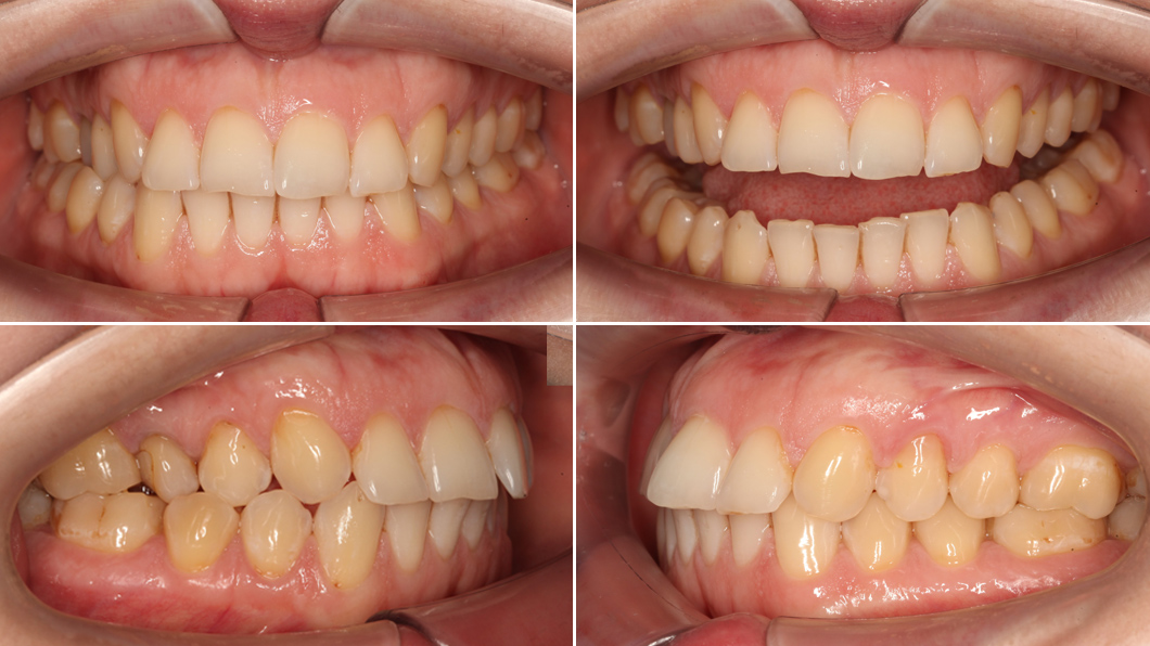 скученность передних зубов