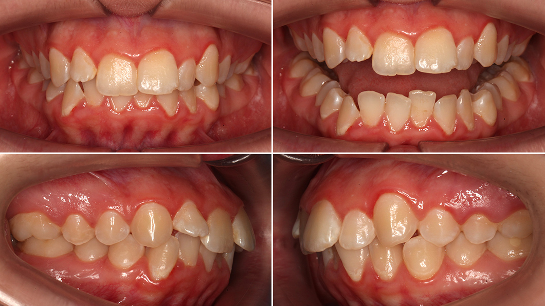 Выраженная скученность