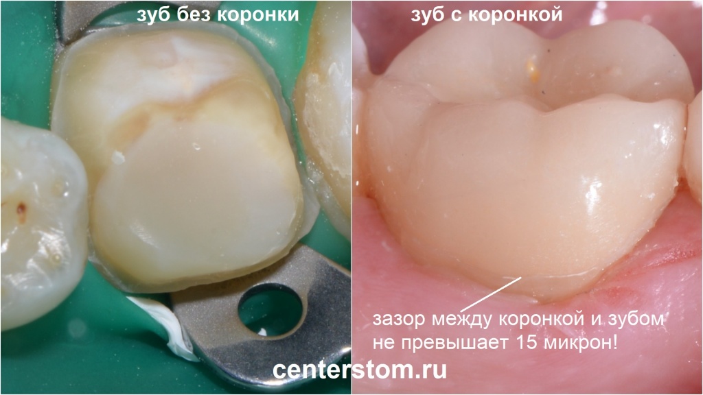 Подготовка зуба к установке коронки и вид зуба после установки коронки E-max