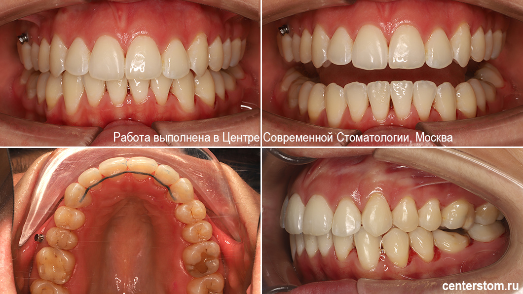 Красивые ровные зубы