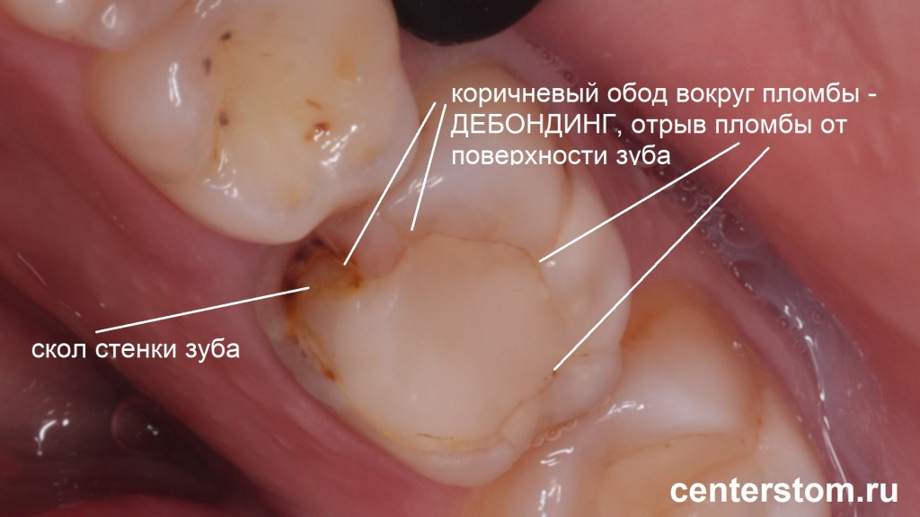 Вид разрушенного зуба вследствии некачественной установки пломбы